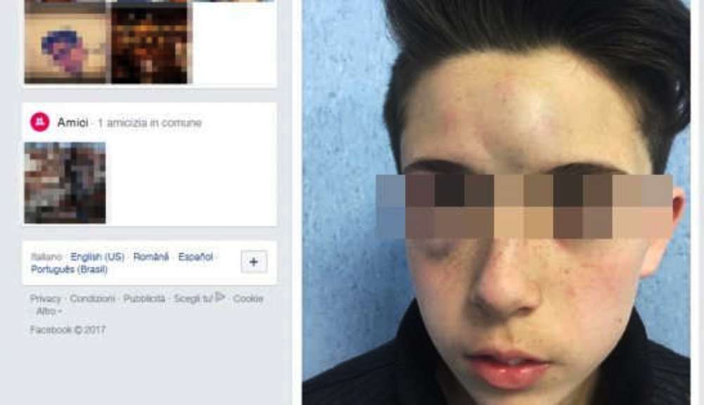 Pestato a 13 anni dai bulli, il padre posta foto shock su Facebook